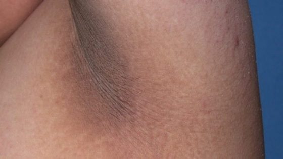 Polycystic Ovary Syndrome (PCOS) - From Diagnosis to Symptoms and Treatment