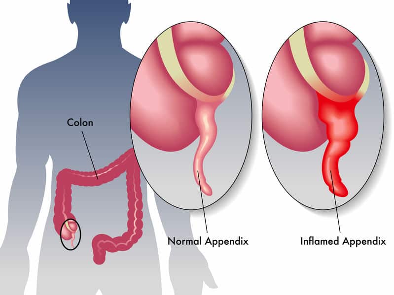 Abdominal pain