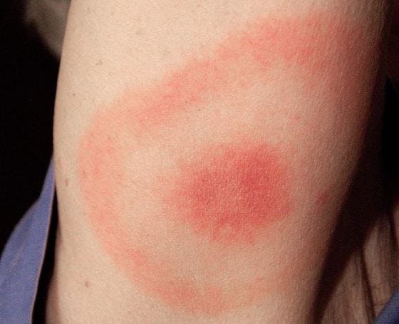 Lyme Disease – 15 Questions and Answers About Causes, Symptoms, Prevention, and Treatment