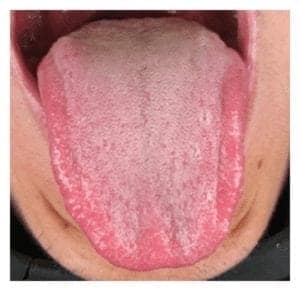 Bad Breath (Halitosis) - 13 Questions and Answers About Bad Breath