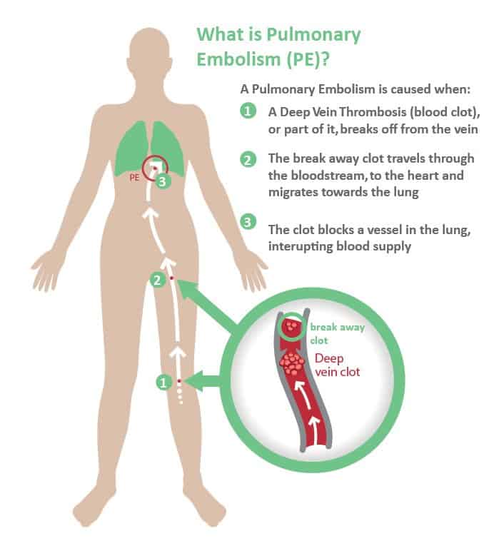 The Truth About Traveling Blood Clots