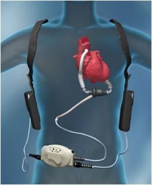 Left ventricular assist device (LVAD)