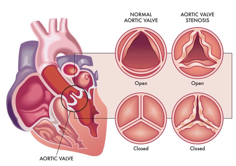 Lipoprotein(a)