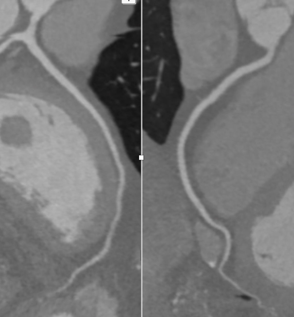 CT Angiography